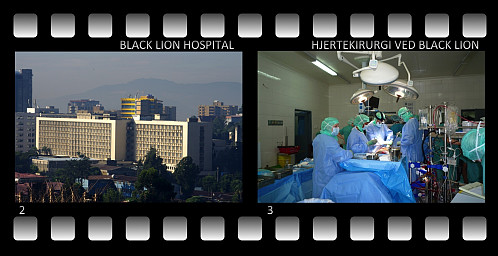 Jeg hadde 15 dager i Addis Ababa i forbindelse med et helseprosjekt. I løpet av disse drøyt to ukene hadde jeg kun én fridag, og den benyttet jeg til å bestige Wochecha, det høyeste av fjellene omkring Addis. 2) Black Lion Hospital sett fra hotellrommet mitt. 3) Hjerteoperasjon på en av operasjonsstuene på Black Lion.