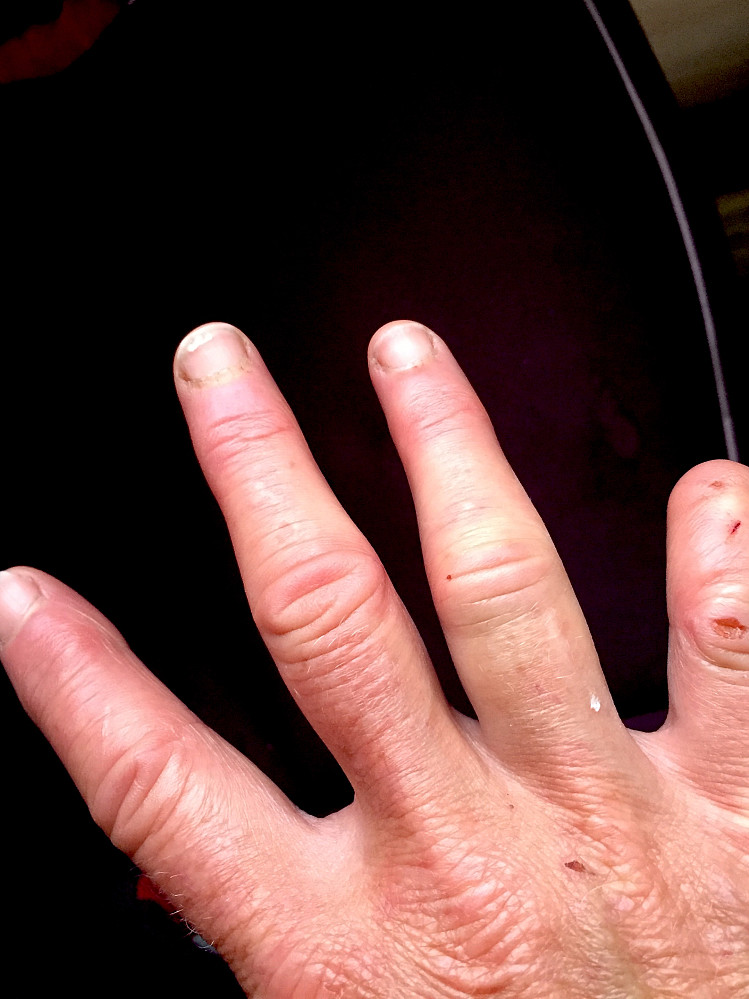 Et litenskliuhell underveis på haglunderlag resulterte i en forhåpentligvis forstuet ringfinger ...